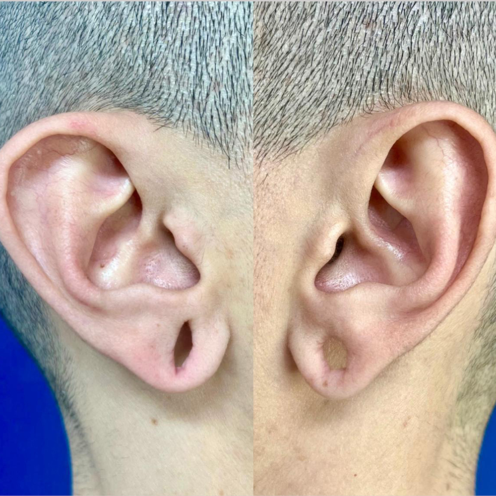 Lobuloplastia bilateral com técnica “snail” invertida para correção de lóbulos deformados por uso prolongado de alargadores