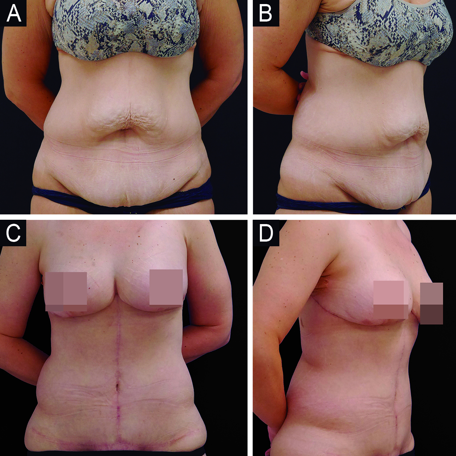 Reação de corpo estranho com infecção grave decorrente de preenchimento facial realizado por profissional não médico