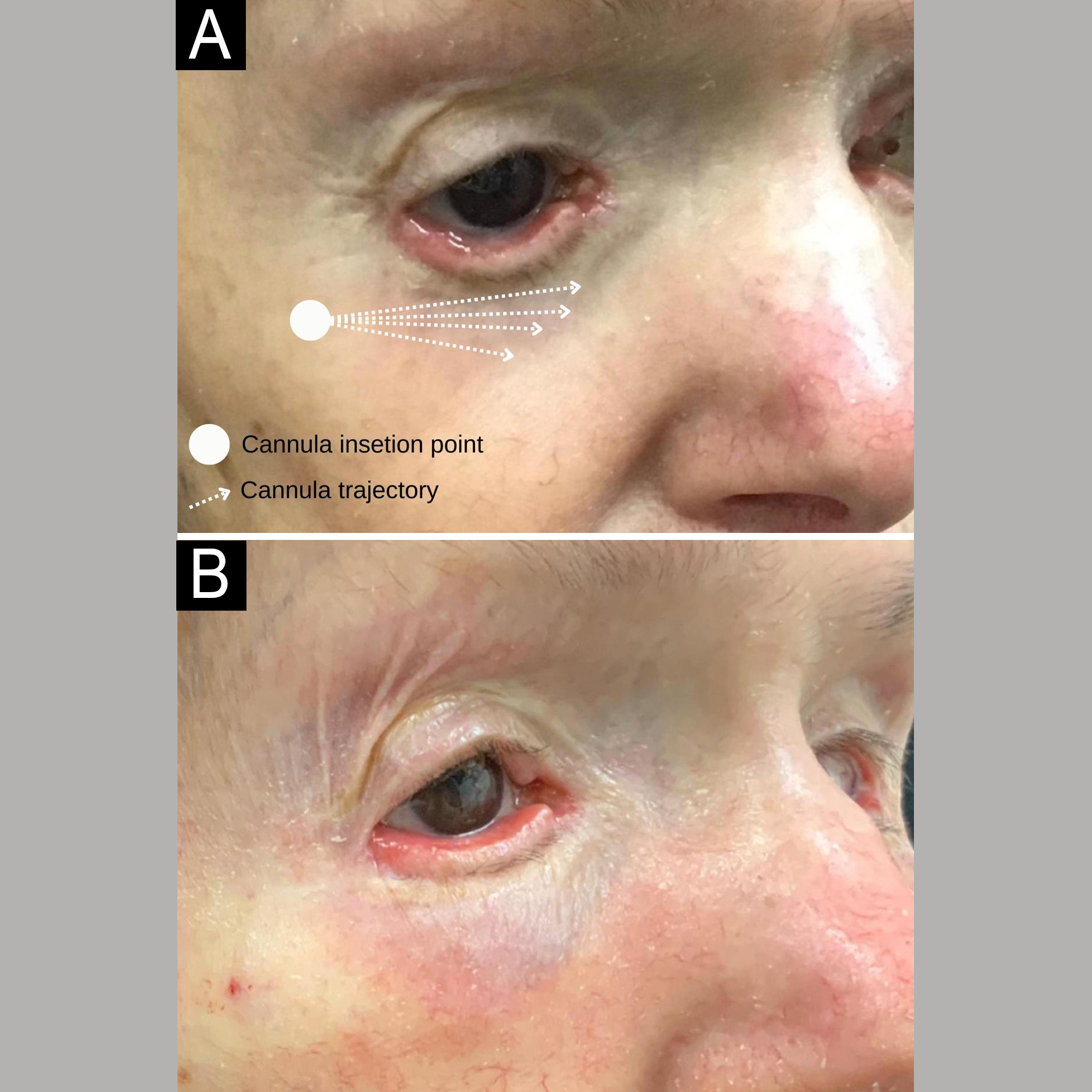 Melanose tumoral - relato de caso