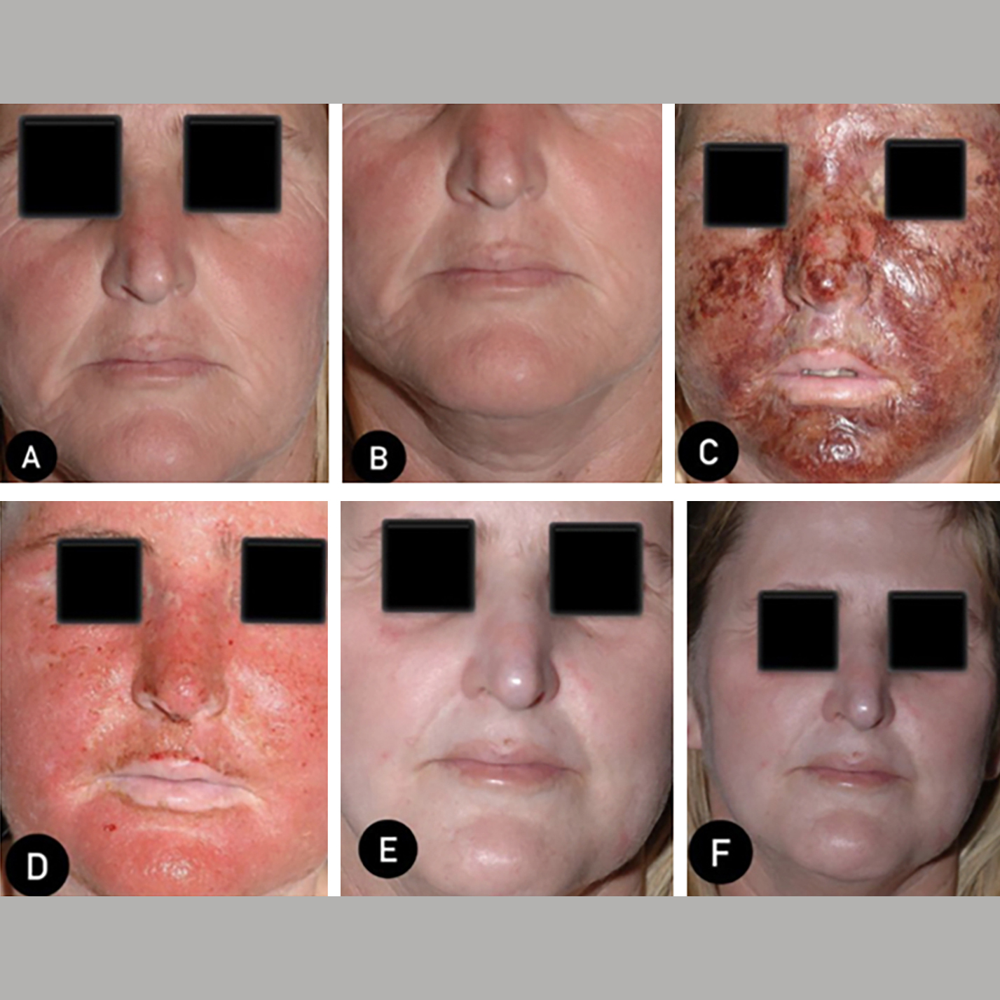 Aplicação de toxina botulínica na cicatrização por segunda intenção