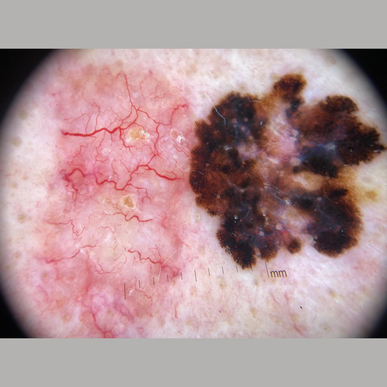 Tratamento combinado para o rinofima
