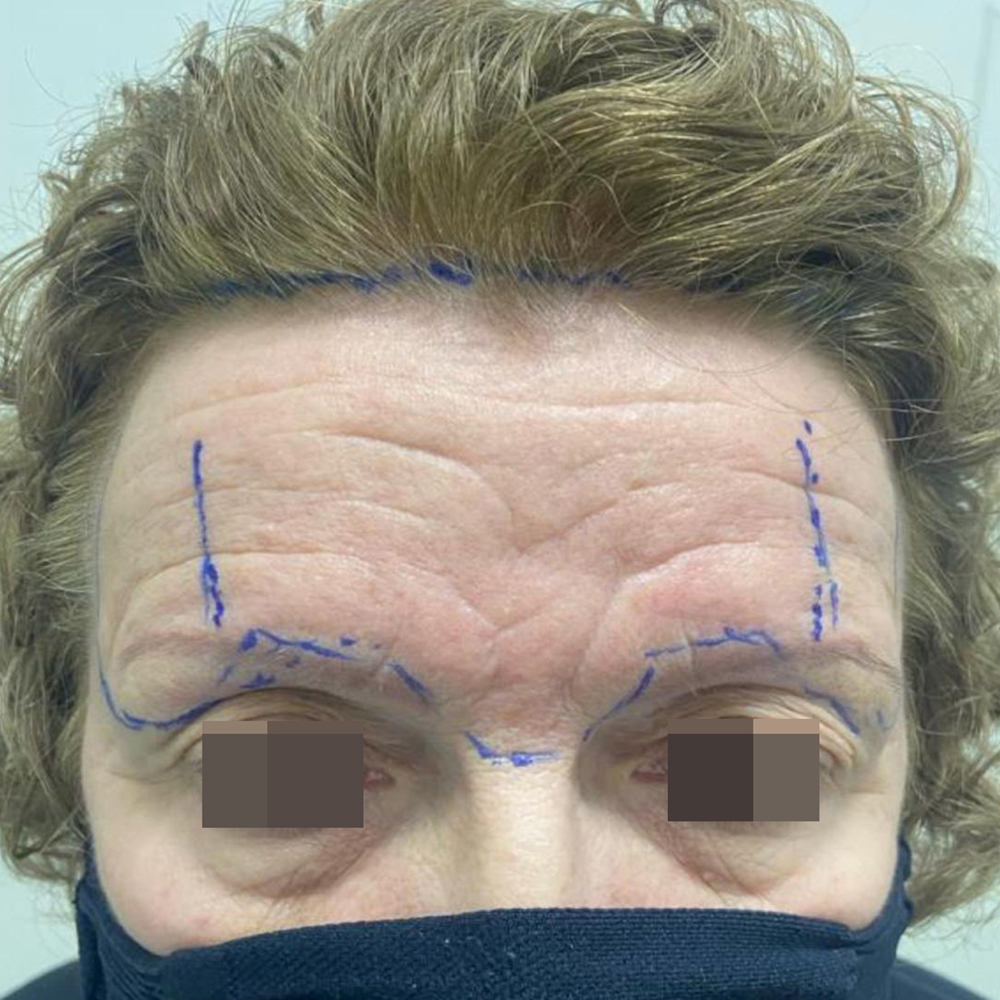 Lifting transfolicular subcutâneo do terço superior da face