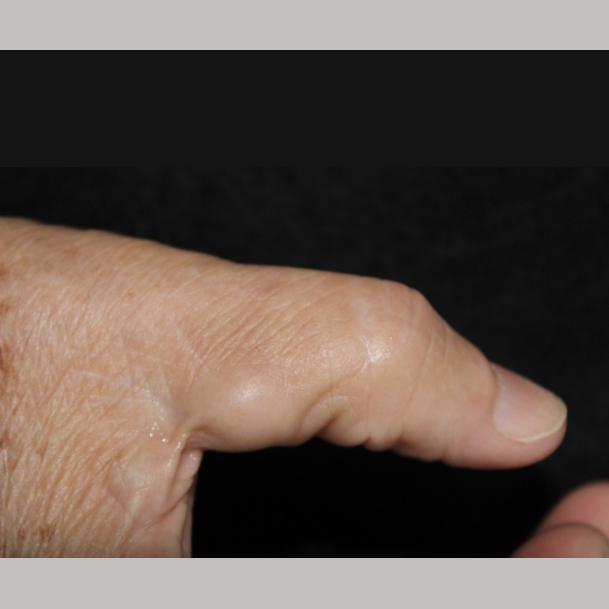 The role of high-frequency ultrasound in the evaluation of an acral subcutaneous nodule: a case report and literature review