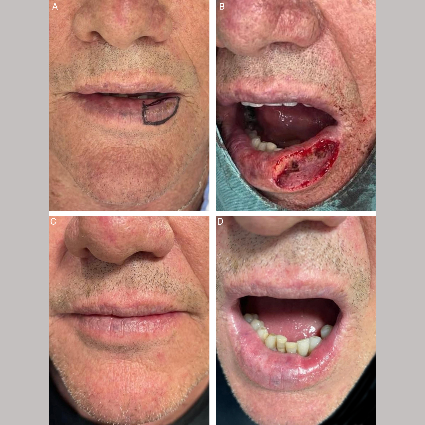 Lip reconstruction using superficial flaps: functional and aesthetic integration