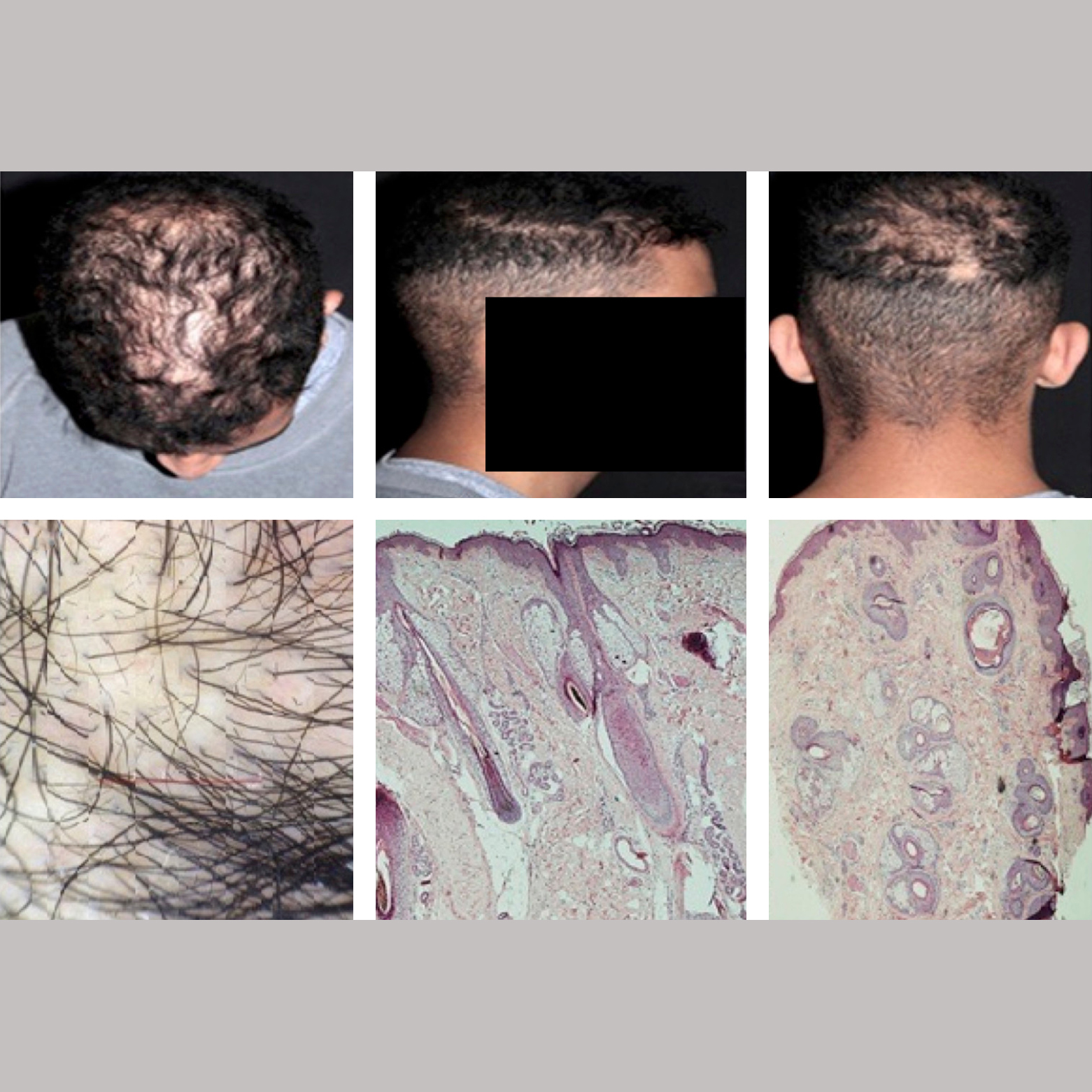 Trichotemnomania in androgenetic alopecia: a case report