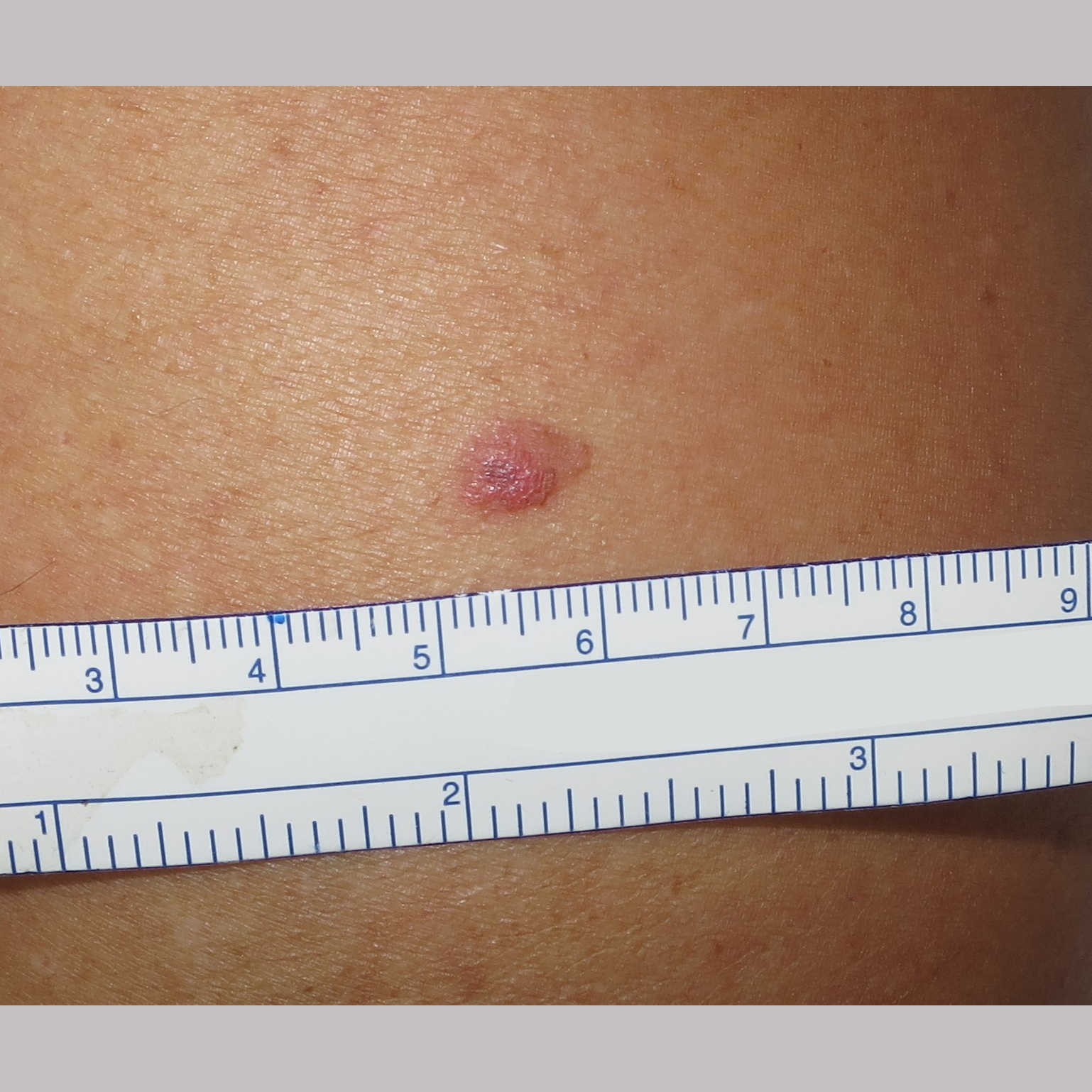 Negative pigment network and its importance in the diagnosis of melanoma: a case report