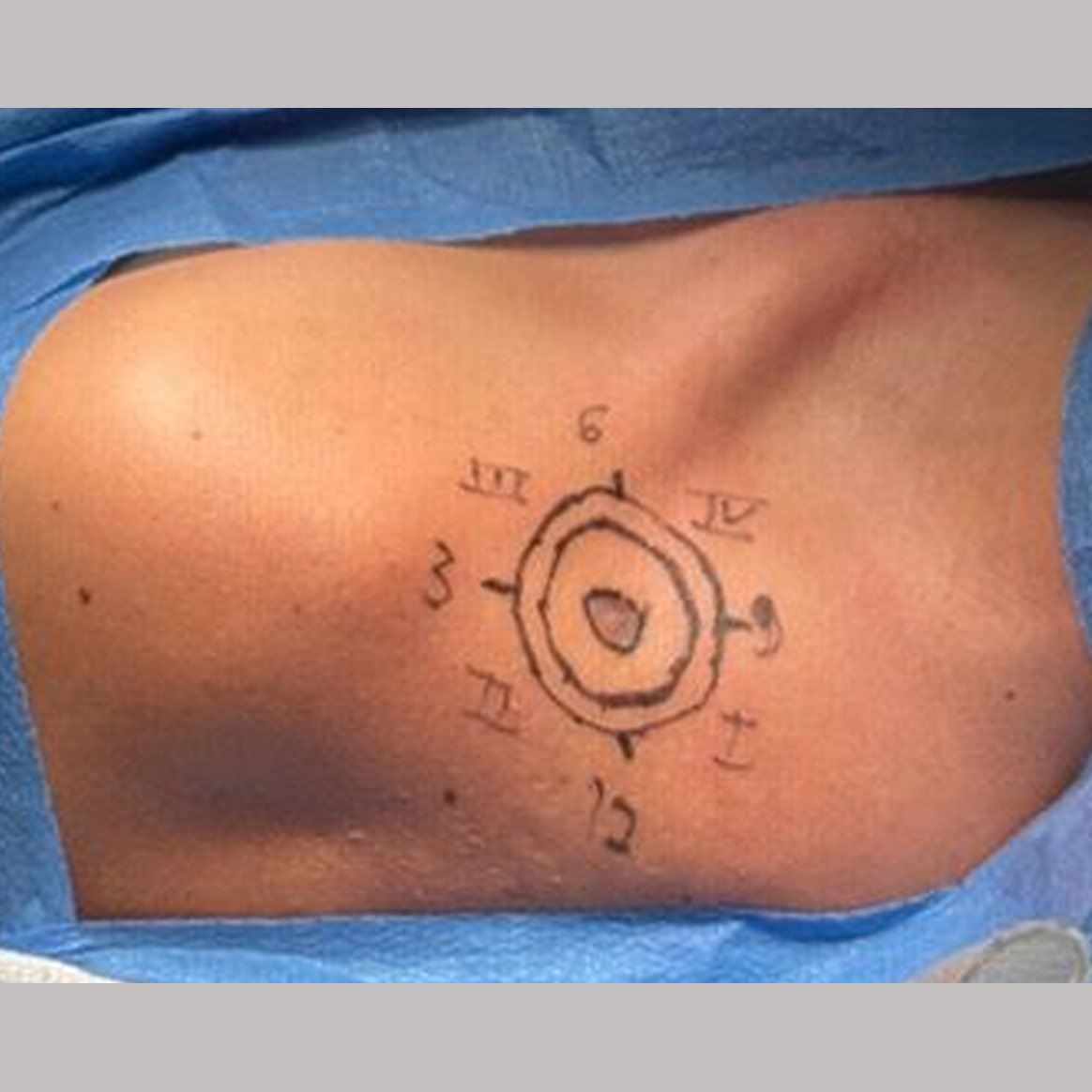 Bednar tumor: a case report