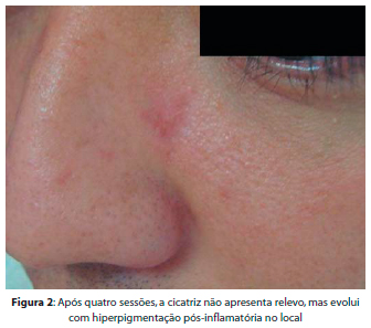 Surgical And Cosmetic Dermatology Tratamento De Cicatriz Atrofica Em Paciente Asiatico Com Laser Fracionado Nao Ablativo Er Glass 1550nm