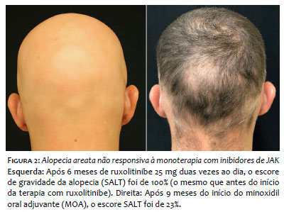 helmintikus terápia alopecia areata)