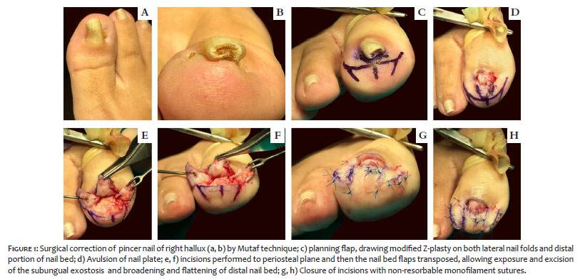 Emuler Compulsion Umulig Surgical & Cosmetic Dermatology | Surgical options for pincer nail  correction