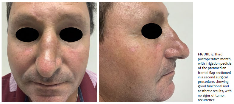 Surgical Cosmetic Dermatology Giant Keratoacanthoma In A Patient