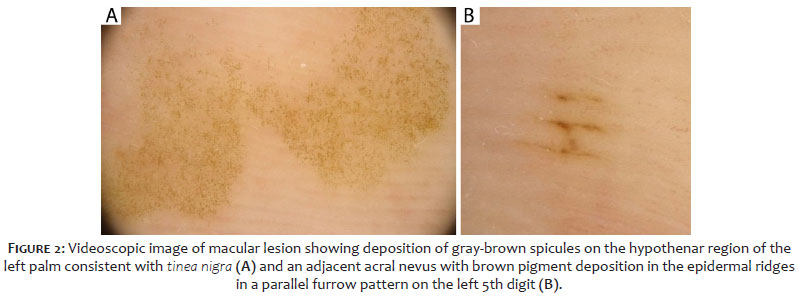 Surgical & Cosmetic Dermatology  Role of Dermoscopy in Distinguishing Tinea  Nigra from Acral Nevus