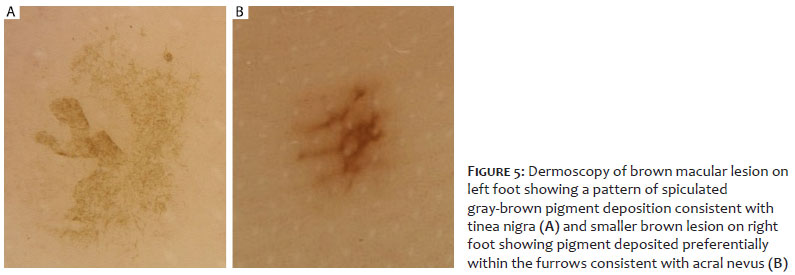 Surgical & Cosmetic Dermatology  Role of Dermoscopy in Distinguishing Tinea  Nigra from Acral Nevus