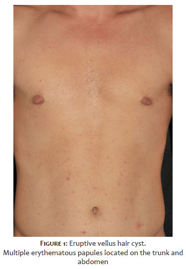 Surgical & Cosmetic Dermatology | Dermoscopy of eruptive vellus hair cyst Surgical & Cosmetic Dermatology | Dermoscopy of eruptive vellus hair cyst