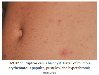 Surgical & Cosmetic Dermatology | Dermoscopy of eruptive vellus hair cyst Surgical & Cosmetic Dermatology | Dermoscopy of eruptive vellus hair cyst