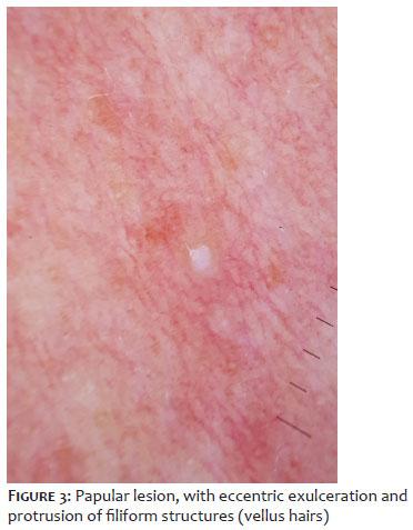 Surgical & Cosmetic Dermatology | Dermoscopy of eruptive vellus hair cyst