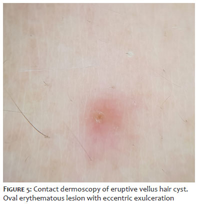 Surgical & Cosmetic Dermatology | Dermoscopy of eruptive vellus hair cyst Surgical & Cosmetic Dermatology | Dermoscopy of eruptive vellus hair cyst