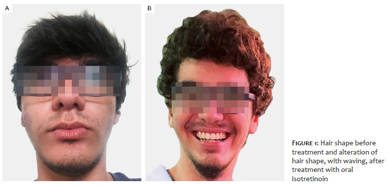 Surgical & Cosmetic Dermatology | Adverse reaction to isotretinoin: alteration of the hair shaft structure Surgical & Cosmetic Dermatology | Adverse reaction to isotretinoin: alteration of the hair shaft structure