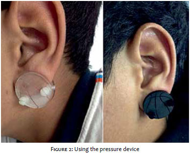 Pressure Earring as an Adjunct to Surgical Removal of Earlobe Keloids -  SAVION - 2009 - Dermatologic Surgery - Wiley Online Library