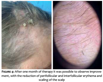 Surgical & Cosmetic Dermatology | Lichen planopilaris: the importance of  early diagnosis